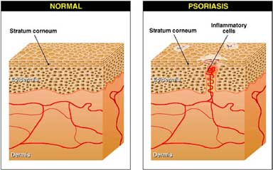 gyógymódok a fejbőr psoriasis véleményeiről)